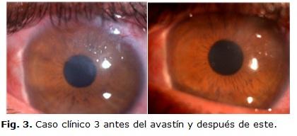 En el ojo izquierdo se observó inyección cilioconjuntival moderada, vascularización corneal superficial y profunda en sector superior, que se extendía desde el limbo hasta zona pupilar (Fig. 3).
