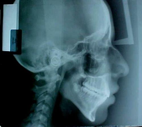 Página 11 Fig. 17 Radiografía lateral de cráneo Estudios intarorales en las fotografías intraorales observamos la corrección de la maloclusion.
