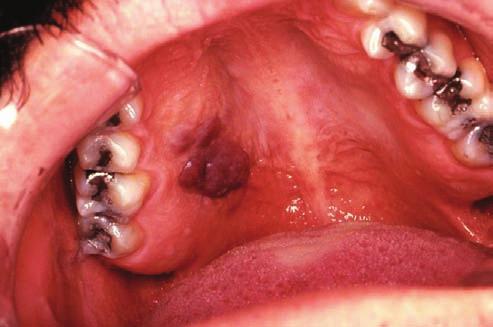 Elena Ortiz L. y cols. Figura 1. Sarcoma de Kaposi asociado a VIH. Placa eritematoviolácea brillante y asintomática en paladar duro.
