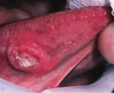 Cáncer de piel asociado a la infección por VIH base de la lengua para el grupo asociado al VPH (Figura 3) y laringe y cavidad oral para el no relacionado al VPH 28.