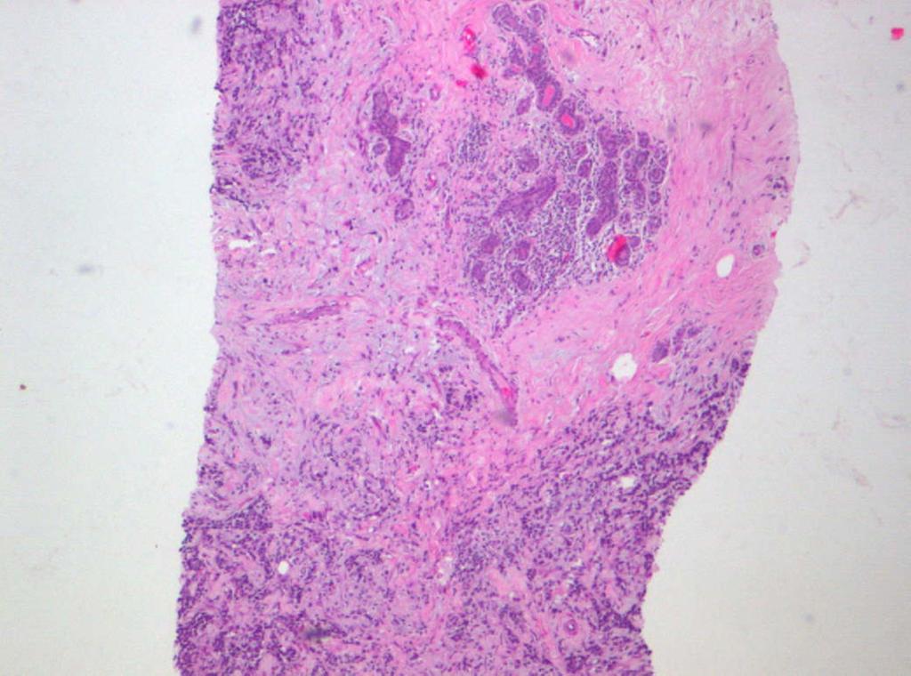 Fig. 2: Muestra de tejido mamario a poco aumento en el que se identifican bandas de tejido fibroso, entre células tumorales,