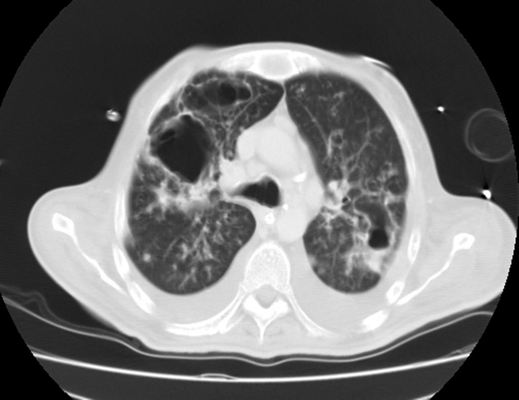 Fig. 7: TC torácico, paciente de Figura 5. Cavernomas pulmonares en LSD, LSI y língula. Derrame pleural bilateral.
