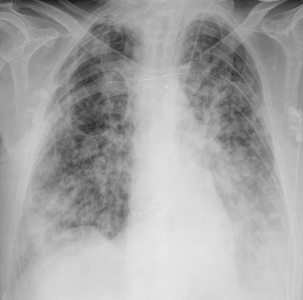 Fig. 5: Varón 55 años, sintomatología sistémica y respiratoria.