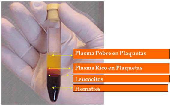 Al centrifugar una muestra de sangre las células, que son más pesadas, quedan en la parte inferior y el plasma asciende a la parte superior.