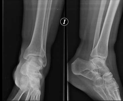 Figura 1. Radiografía simple AP y lateral de tobillo izquierdo. Lesión quística radiolúcida en calcáneo, bien definida y bordes esclerosos. Figura 2.