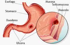 Úlcera: erosión de la mucosa que se profundiza más allá de la muscularis mucosae ÚLCERA PÉPTICA Factores de riesgo de las UP: 1. Infección por H.