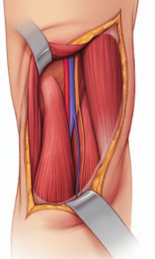4 Retracción del músculo semimembranoso Identifique el músculo semimembranoso y desplácelo en sentido medial. Resulta así visible la inserción proximal del músculo gemelo interno.