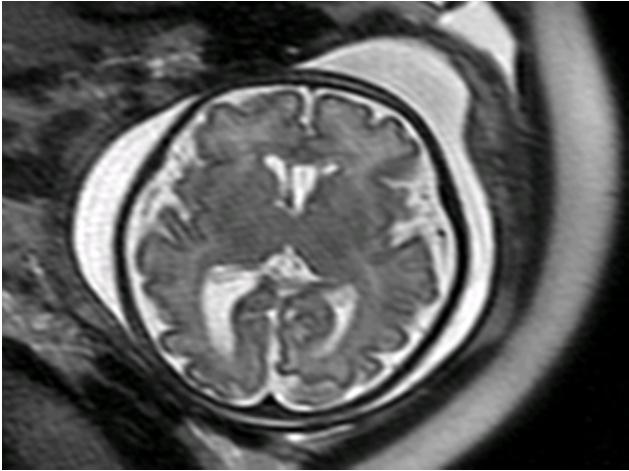 CMV: diagnóstico afectación fetal RM intracraneal 30 s: SNC: RM y neurosonografía son