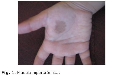 INTRODUCCIÓN La tiña negra (tinea nigra) es una micosis superficial causada por un hongo levaduriforme dematiáceo denominado Hortaea werneckii.