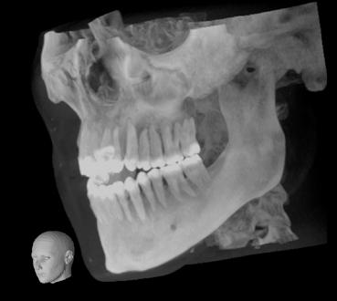 Función zoom 3D reconstruction Función de marcado del canal nervio dentario