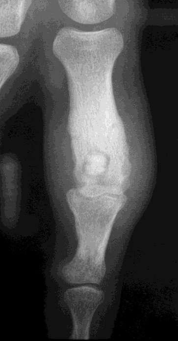 An osteoblastic-osteoid tissue forming tumor of a