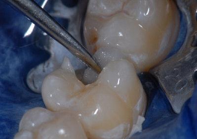 Ajuste en boca A continuación, ajustar la restauración cuidadosamente en la boca. Comprobación de los contactos proximales con hilo dental.