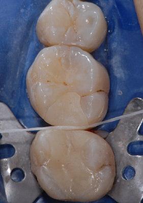 Fijación adhesiva Descripción paso a paso tomando un onlay como ejemplo Acondicionamiento de la sustancia dental Prueba en boca de la