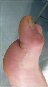 En el primer dedo suelen realizarse como acto quirúrgico en diferentes patologías: dedo en martillo en pies neurológicos, pies reumáticos, o secuelas de otras cirugías.