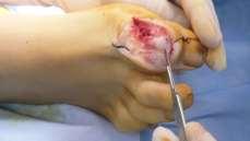 implantación de la artrodesis(figura 0).