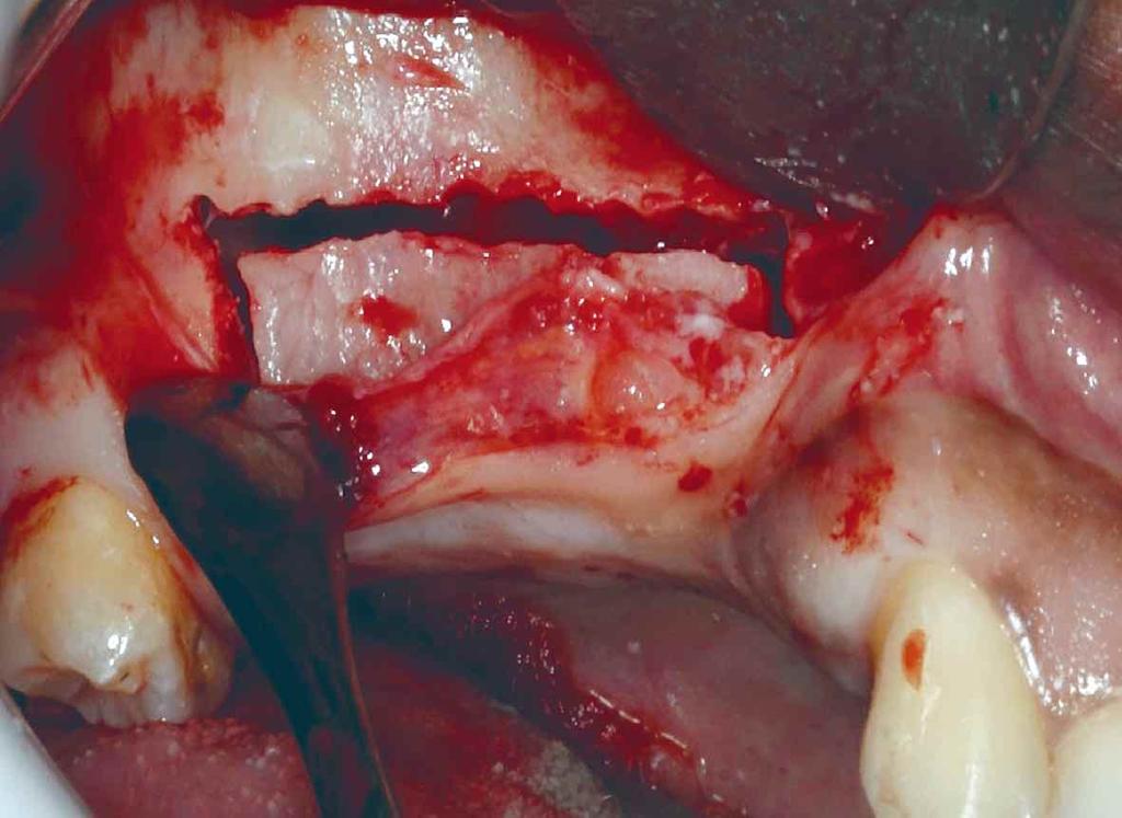 defectos moderados del reborde alveolar, donde es posible mejorar en altura cerca de 4 a 9 mm y también para los casos de reposición de implantes en posiciones inadecuadas (Schettler & Holtermann;
