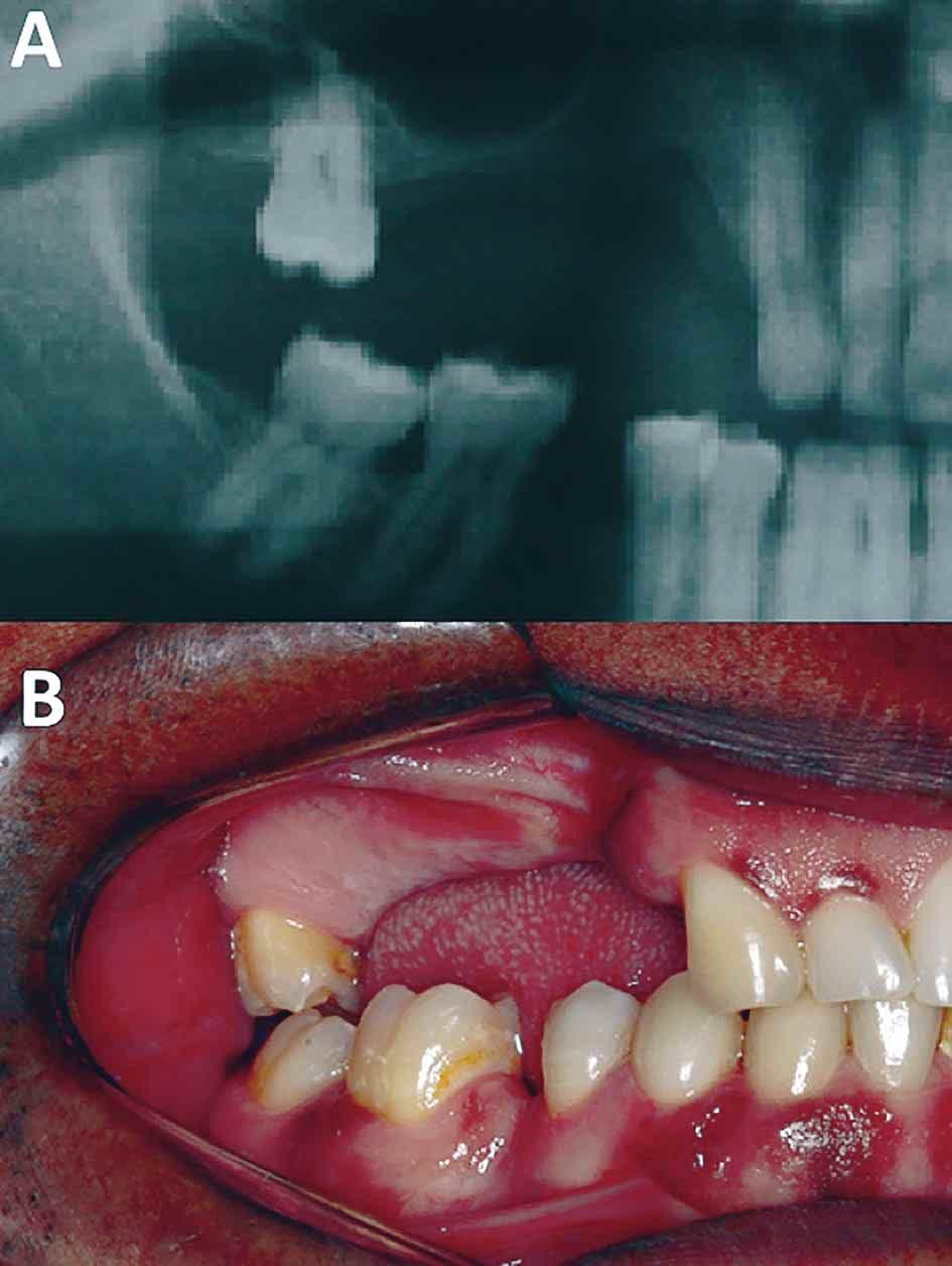 Limitados reportes existen sobre la osteotomía segmentaria en el sector posterior de maxila, principalmente debido a la complejidad anatómica del seno maxilar y a la calidad ósea de contenido mas