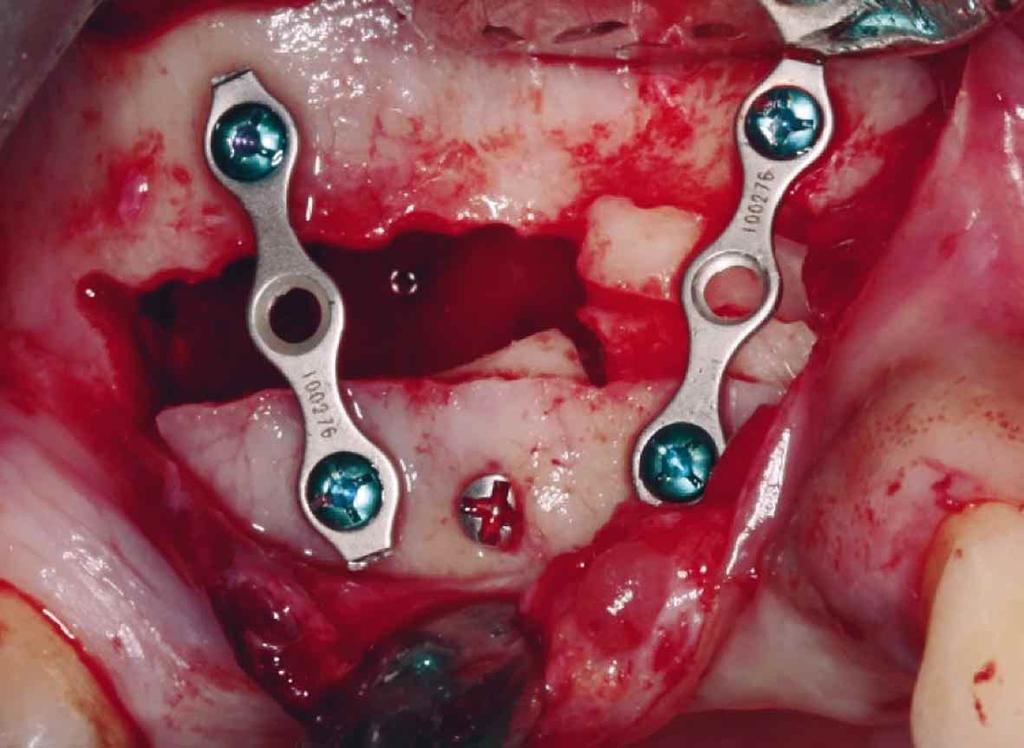 5); la técnica quirúrgica finaliza con la incorporación de una membrana biológica de colágeno en el sector lateral.