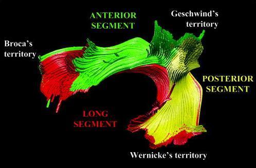 Zonas afectan lenguaje mas lesiones permanentes en el área del fasiculo arqueado llamada de Geschwind: Brain Arteriovenous Malformations Located in Language Area: Surgical Outcomes and Risk Factors