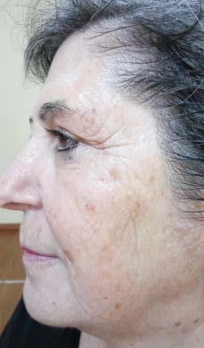 NOVASONIX, CASO DE ÉXITO Paciente de 65 años. Resultados tras cuatro sesiones de tratamiento.