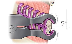 Cada fractura se debe estabilizar con al menos dos segmentos del clip (mejor tres) laterales a la fractura.