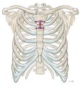 localización dorsal) dolores intensos no tratables, incluso en caso de fracturas individuales estados de dolor crónico con osteoformación incompleta tras fracturas costales (pseudoartrosis/neuroma