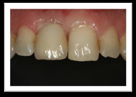 Disciplinas de apoyo en la clínica implantológica: fotografía dental y consentimiento informado.
