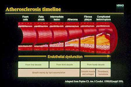 Transcurso de la aterosclerosis Células vacuoladas Estrías lipídicas Lesión intermedia Ateroma Placa fibrosa Placa complicada Lesión-ruptura Disfunción endotelial Desde la 1a