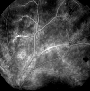 torácico + RMN cerebral + Gammagrafia con Galio * Retinal