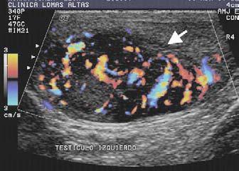 masa sólida en el parénquima testicular ecogenicidad baja, heterogénea, con o