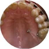 TRATAMIENTOS INTERDISCIPLINARES 17/5/19-18/5/19 > Particularidades del tratamiento de ortodoncia en el paciente adulto > Ortodoncia y periodoncia. Lo que todo ortodoncista debe conocer.