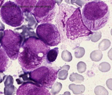 Leucemia promielocítica aguda Diagnóstico LMA M3 de la clasificación FAB Morfología: Blastos hipergranulares con abundantes