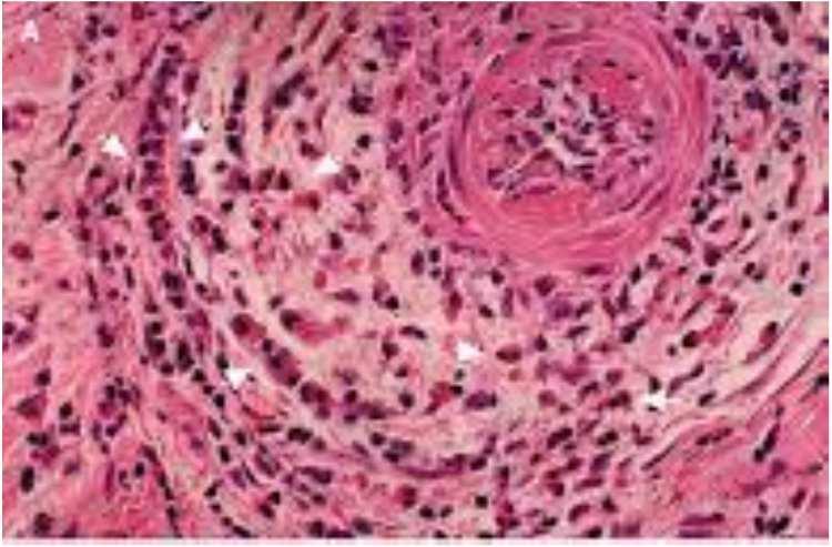 Biopsia cutánea Tronco: Edema perivascular con algunos eosinófilos.