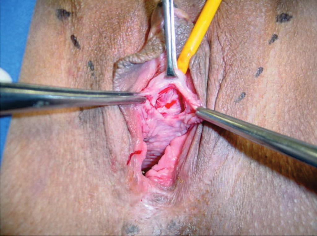 Sling Auto Fijable y Regulable Transobturatriz: Safyre T Plus Figura 3: Incision Vaginal. medio e inferior de la uretra, profundizando en la totalidad de la pared vaginal y la fascia de Halban.