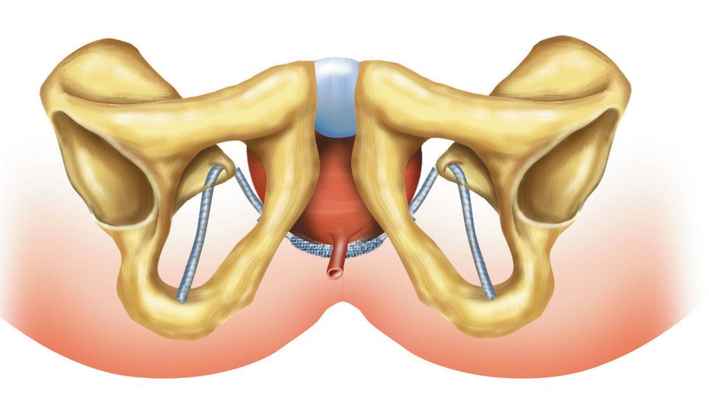 Traccionar suavemente ambas columnas del SAFYRE, hasta que el mismo entre en contacto con la uretra sin tensión.