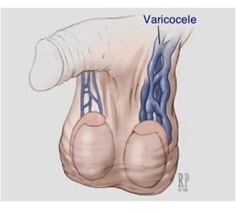 Masas escrotales Varicocele Dilatación varicosa del plexo pampiniforme.
