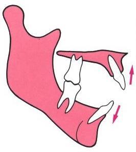 La combinación de las rotaciones del maxilar y mandíbula Rotación divergente de las bases