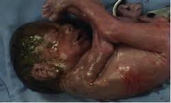Prevención: La aspiración en presencia de líquido amniótico con meconio, si el recién nacido no está vigoroso (respiración