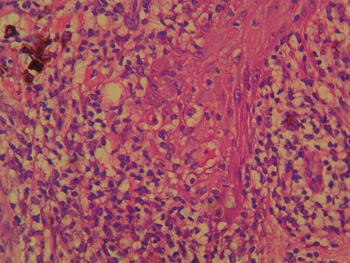 La dermis papilar exhibe edema, vasocongestión y marcada incontinencia de pigmento (Fig. 4). Diagnóstico: reacción hística liquenoide compatible con LPP. Fig.