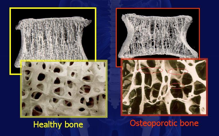 OSTEOPOROSIS Definición Es una enfermedad metabólica de los huesos que