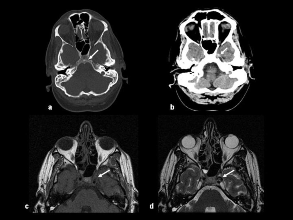 Fig. 15: Paciente con accidente de tráfico y TCE con fractura de la base de cráneo que afecta al clivus y alcanza el seno cavernoso izquierdo (a).