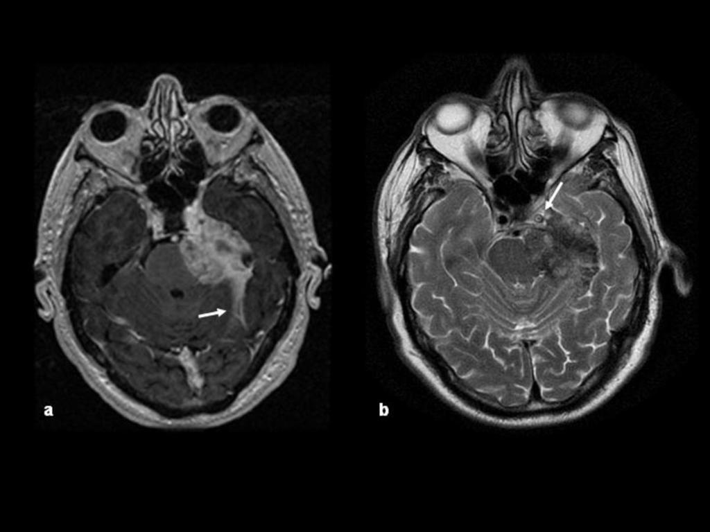 Fig. 5: Extenso meningioma de la incisura petroclival, con invasión del SC izquierdo.