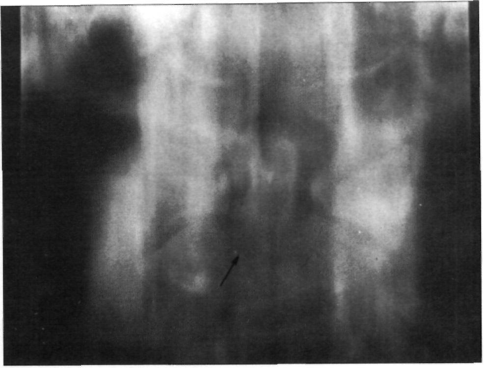 158 REVISTA ESPAÑOLA DE CIRUGÍA OSTEOARTICULAR Figura 1B. Proyección transbucal: La fractura de odontoides presenta un trazo de fractura que abarca parte del soma vertebral de C2. po I de Effendi (5).