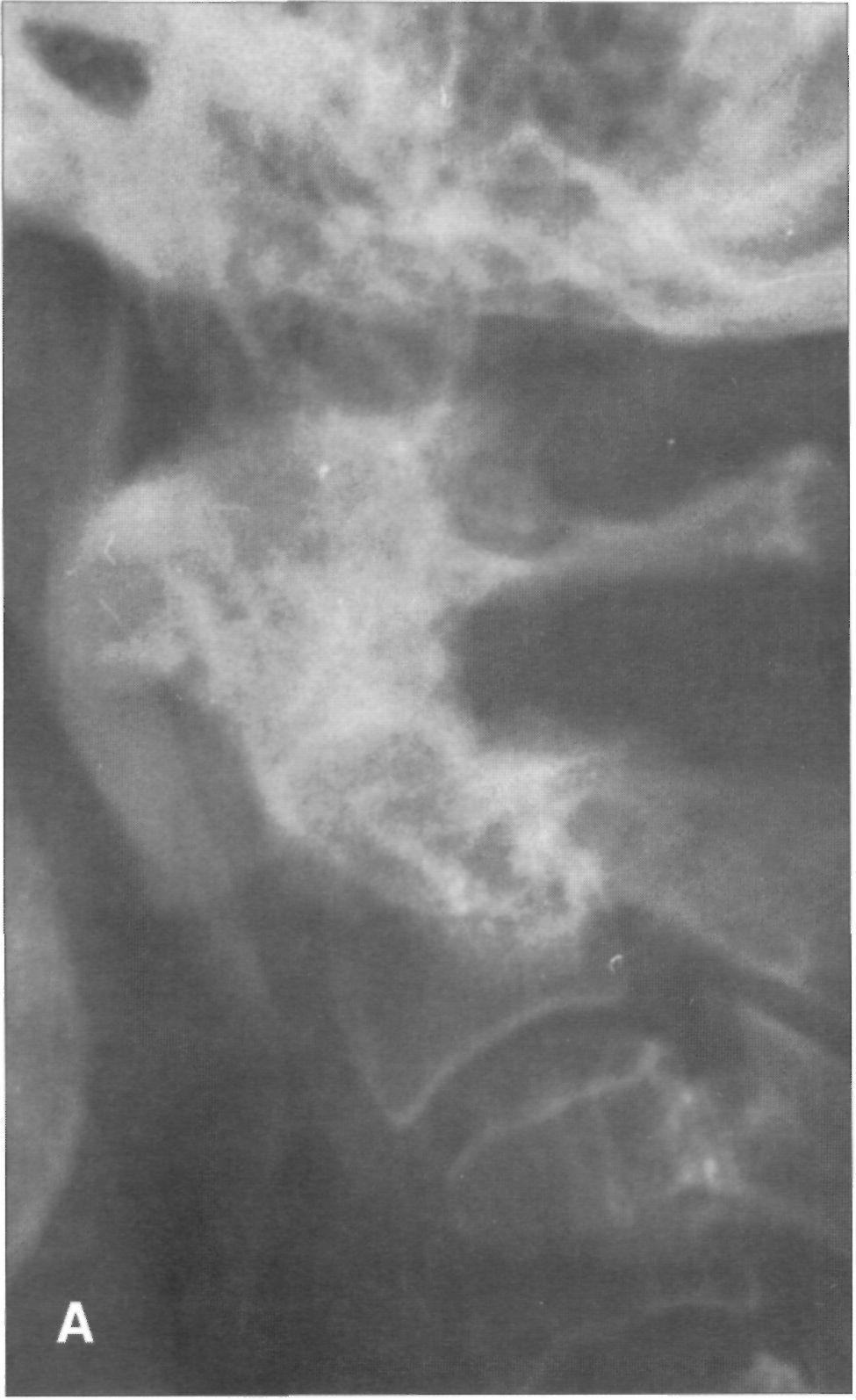 TAC: Fractura bilateral a nivel posterior del soma de C2, representando una variante de la fractura de Hangman; en lugar de afectar los pedículos, la fractura es somática.