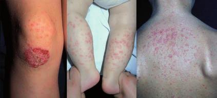 13-15 Muchas dermatofitosis superficiales pueden tratarse eficazmente con antifúngicos tópicos.