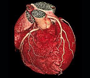 Biomarcadores en Corazón Isquemia miocárdica La detección del área miocárdica a riesgo y el edema mediante RM permite evaluar el daño inducido por reperfusión y detectar los cambios en el miocardio.