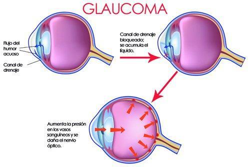 Enfermedades de la visión: Glaucoma Presión intraocular sobre los 20 mmhg