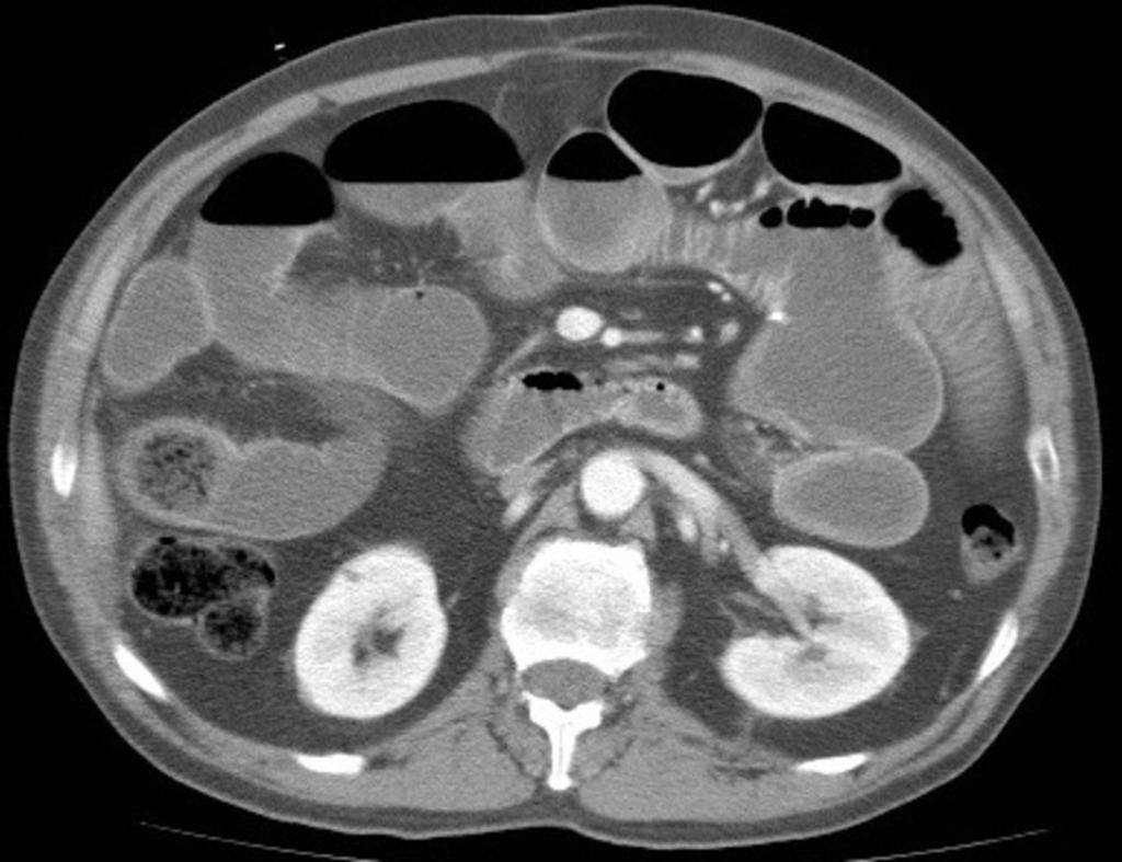 Fig. 4: Paciente con obstrucción de intestino delgado.