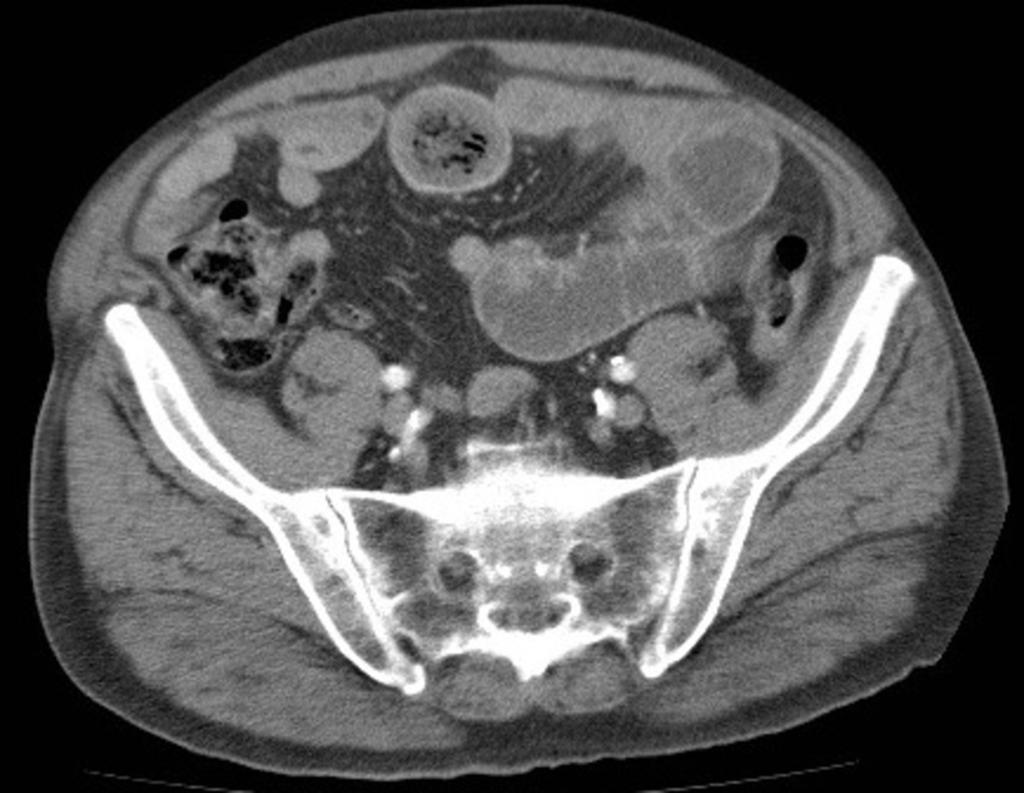 Fig. 5: Se realiza TC abdominopélvico en paciente con obstrucción intestinal por bezoar, que muestra lesión ovoidea intraluminal en la zona de cambio de