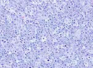 ACTUALIZACION 2016 Linfoma de células B de alto grado OMS 2008: linfoma B no clasificable, con